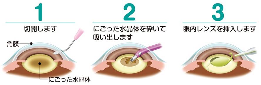 眼科 診療科 部門紹介 社会福祉法人 三井記念病院