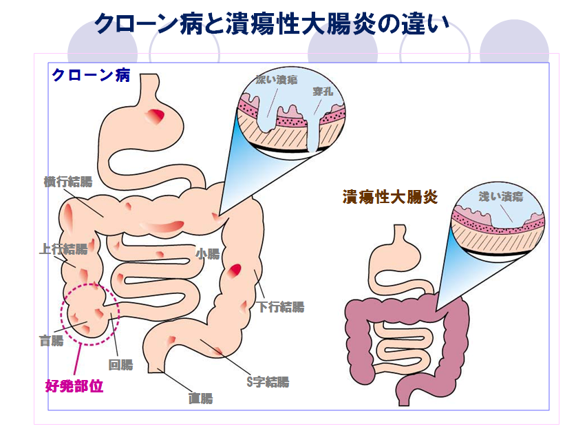 炎症 性 腸 疾患 に関する 記述 で ある