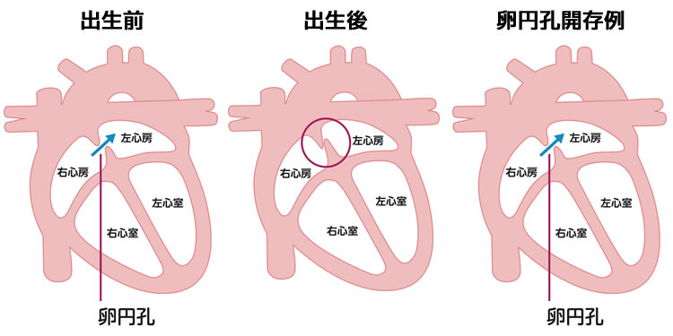 図1　卵円孔開存のイメージ