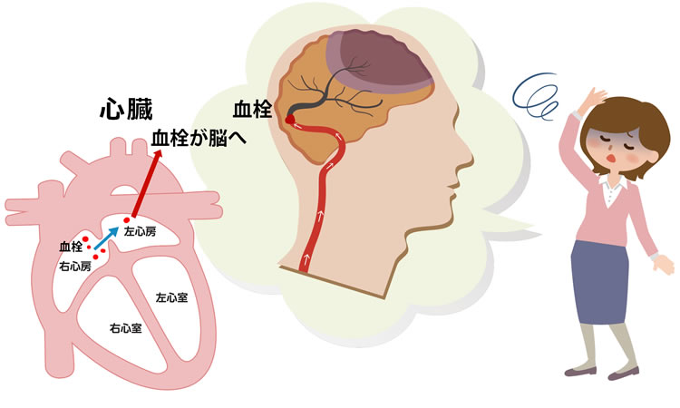図2　奇異性脳塞栓症のイメージ