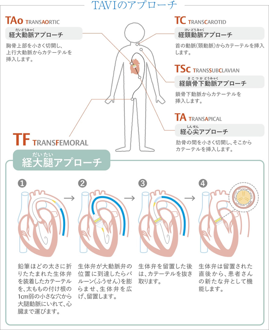 TAVIのアプローチ