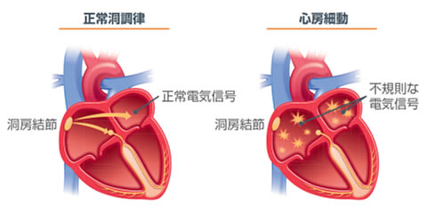 図1　心房細動と正常洞調律の違い