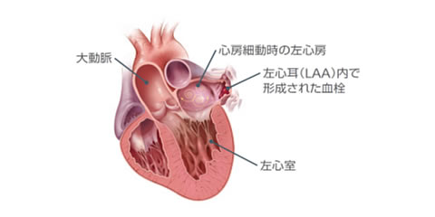 図2　心房細動時の左心耳内血栓